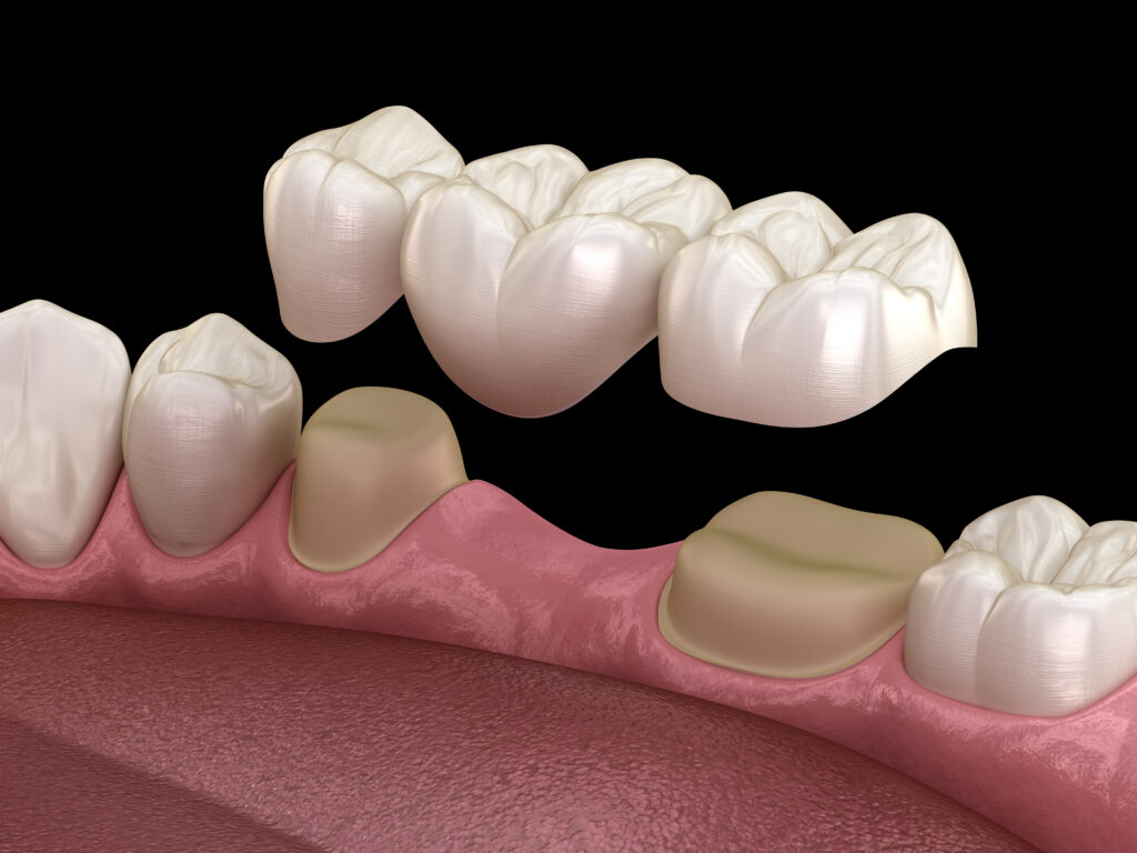 A custom dental bridge restoring a natural-looking smile.