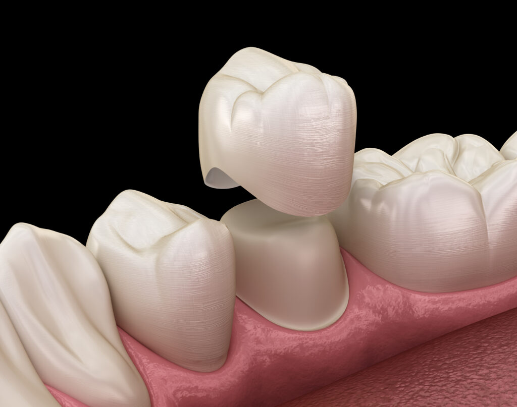Close-up view of a high-quality dental crown restoration.