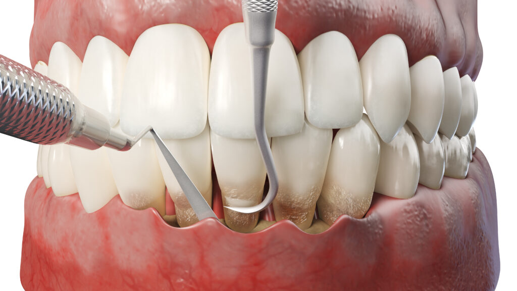 A dental professional performing a thorough evaluation of a patient's gum health.