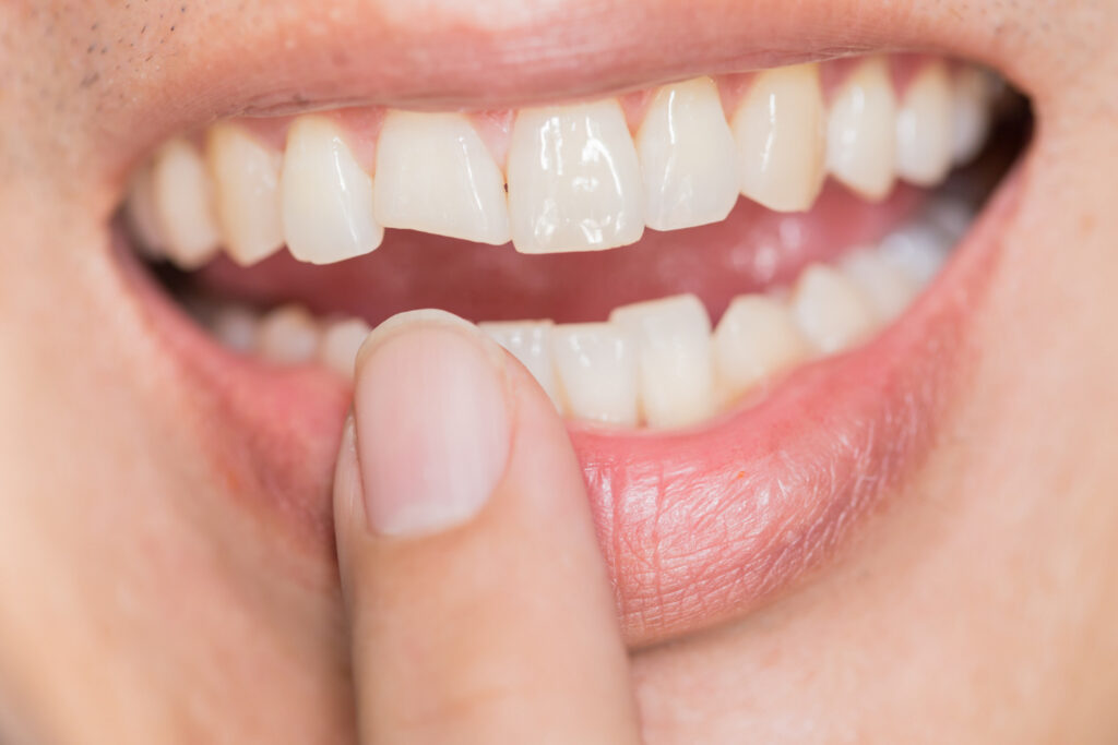 What Can Cosmetic Bonding Fix Beyond Chipped Teeth?