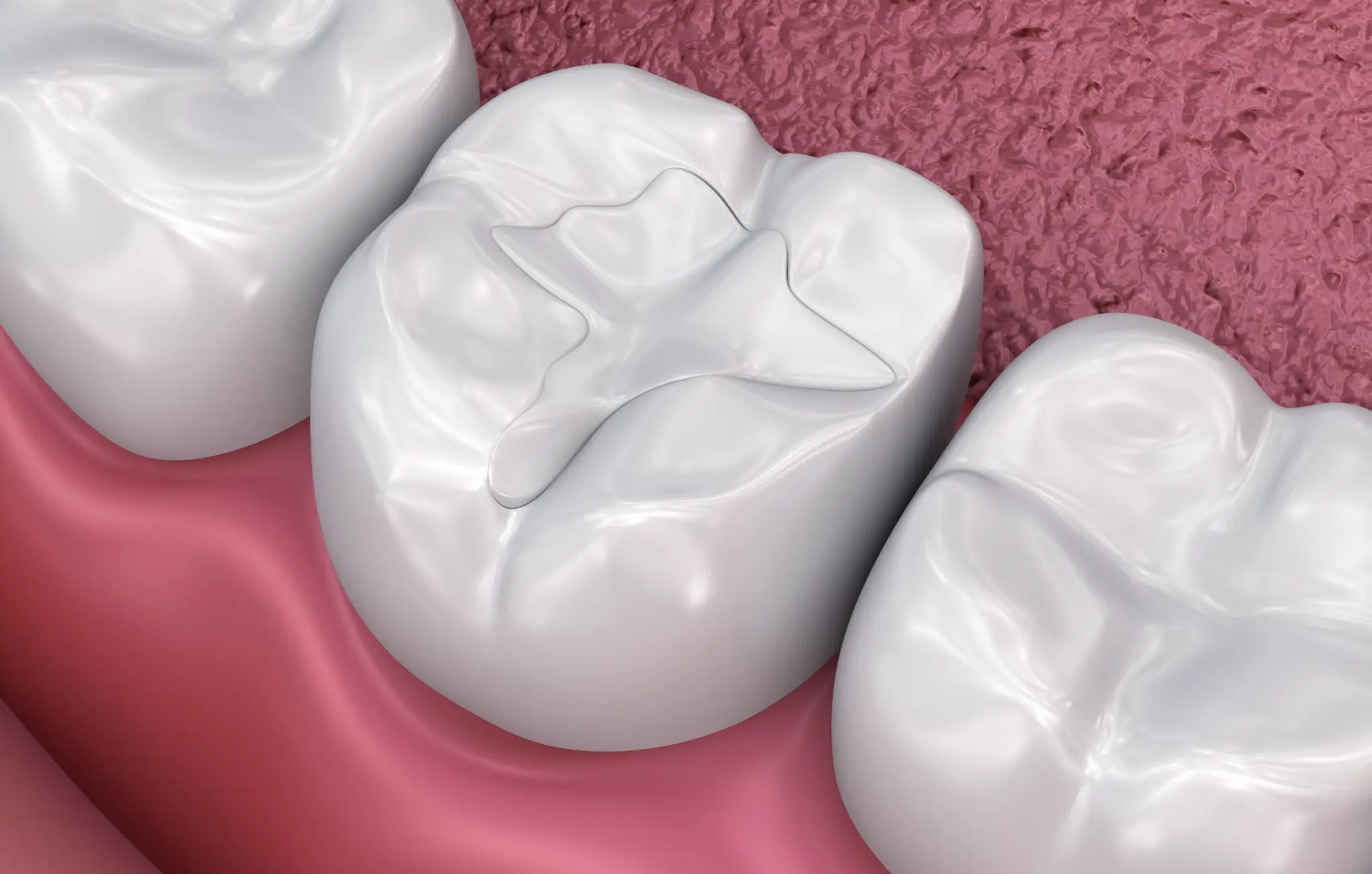 Illustration of a tooth with a tooth-colored composite filling.