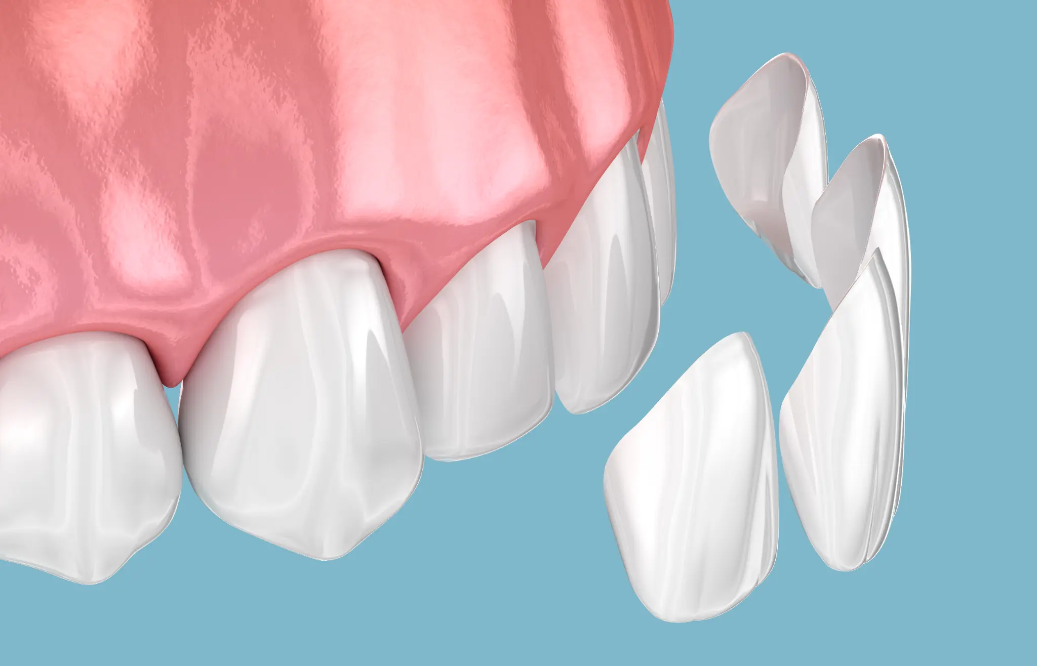 Illustration of dental veneers being positioned beside front teeth.