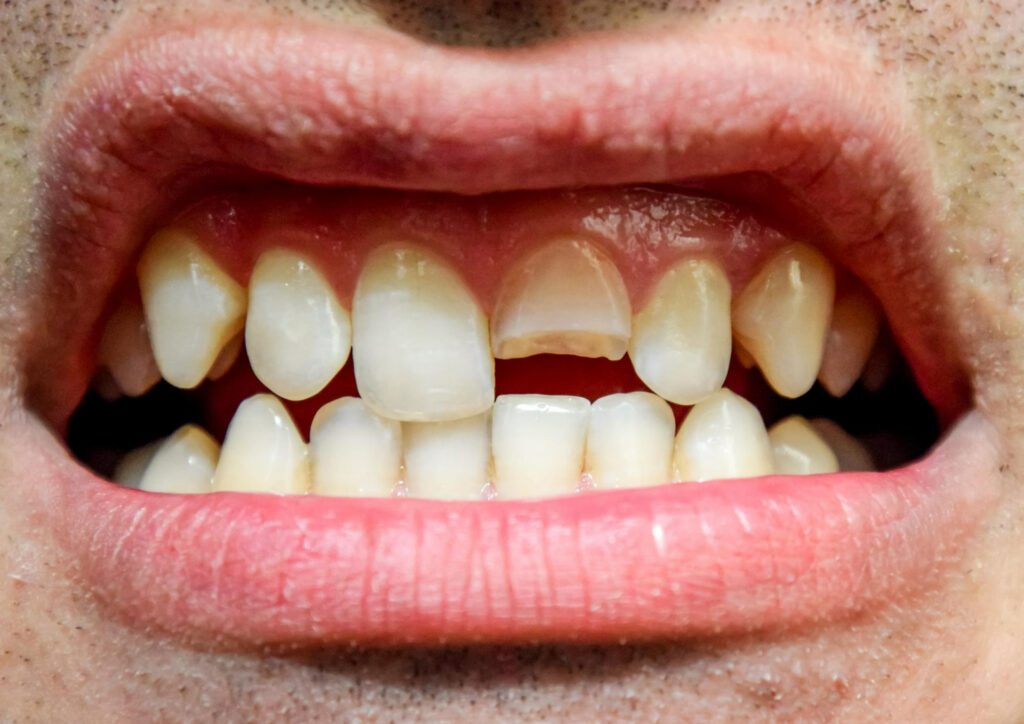 How Dental Crowns Help With Cracked or Worn Teeth