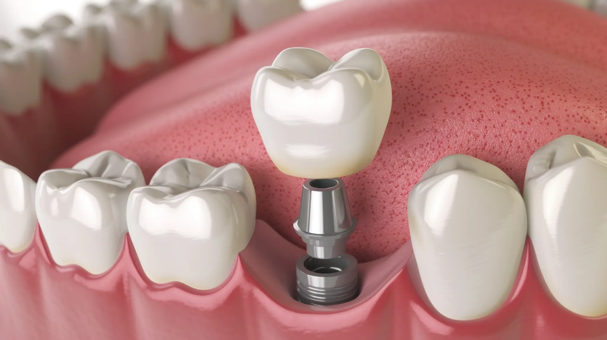 Illustration of a dental implant and crown replacing a missing tooth.