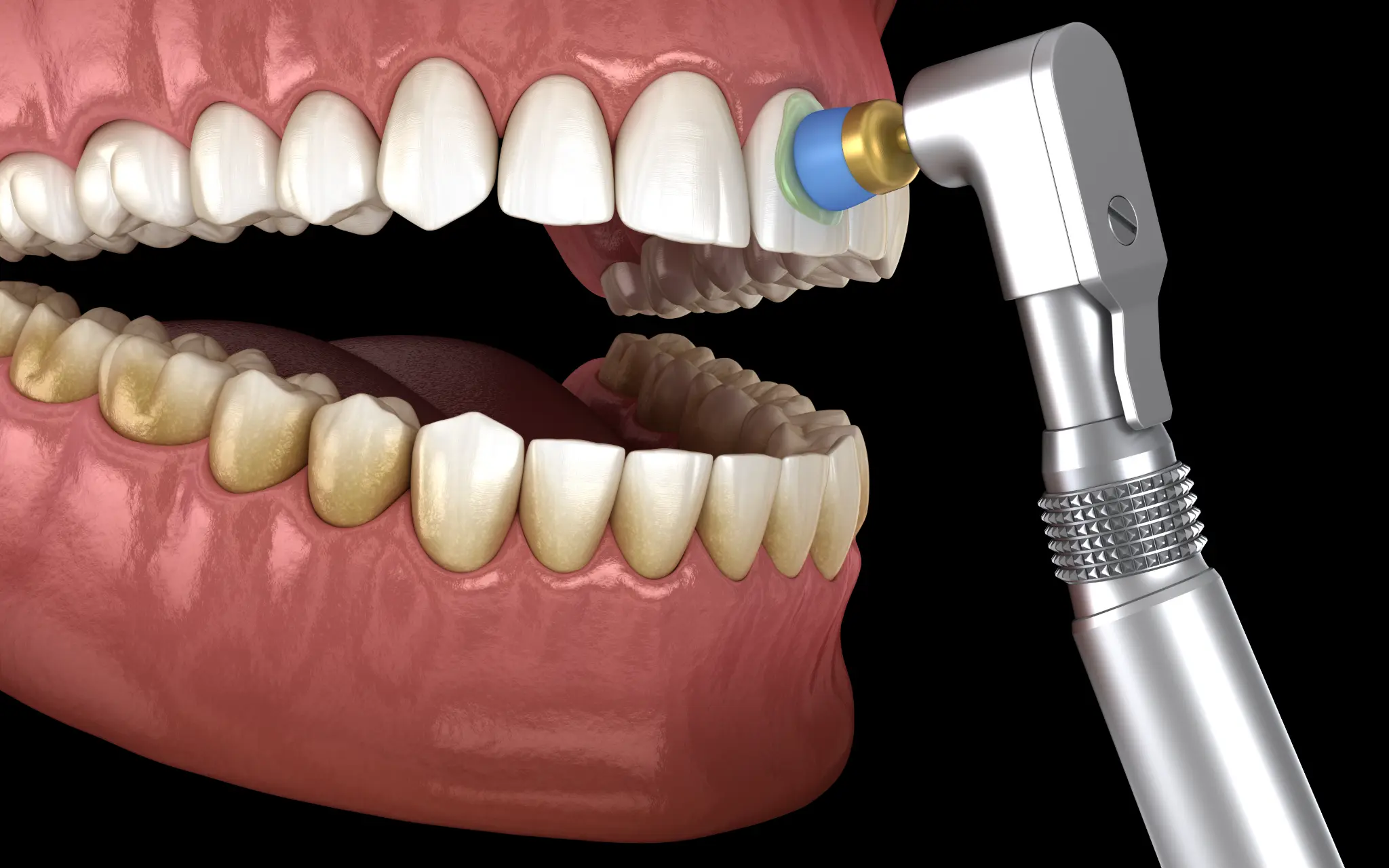 Illustration of a dental polishing tool cleaning a tooth.