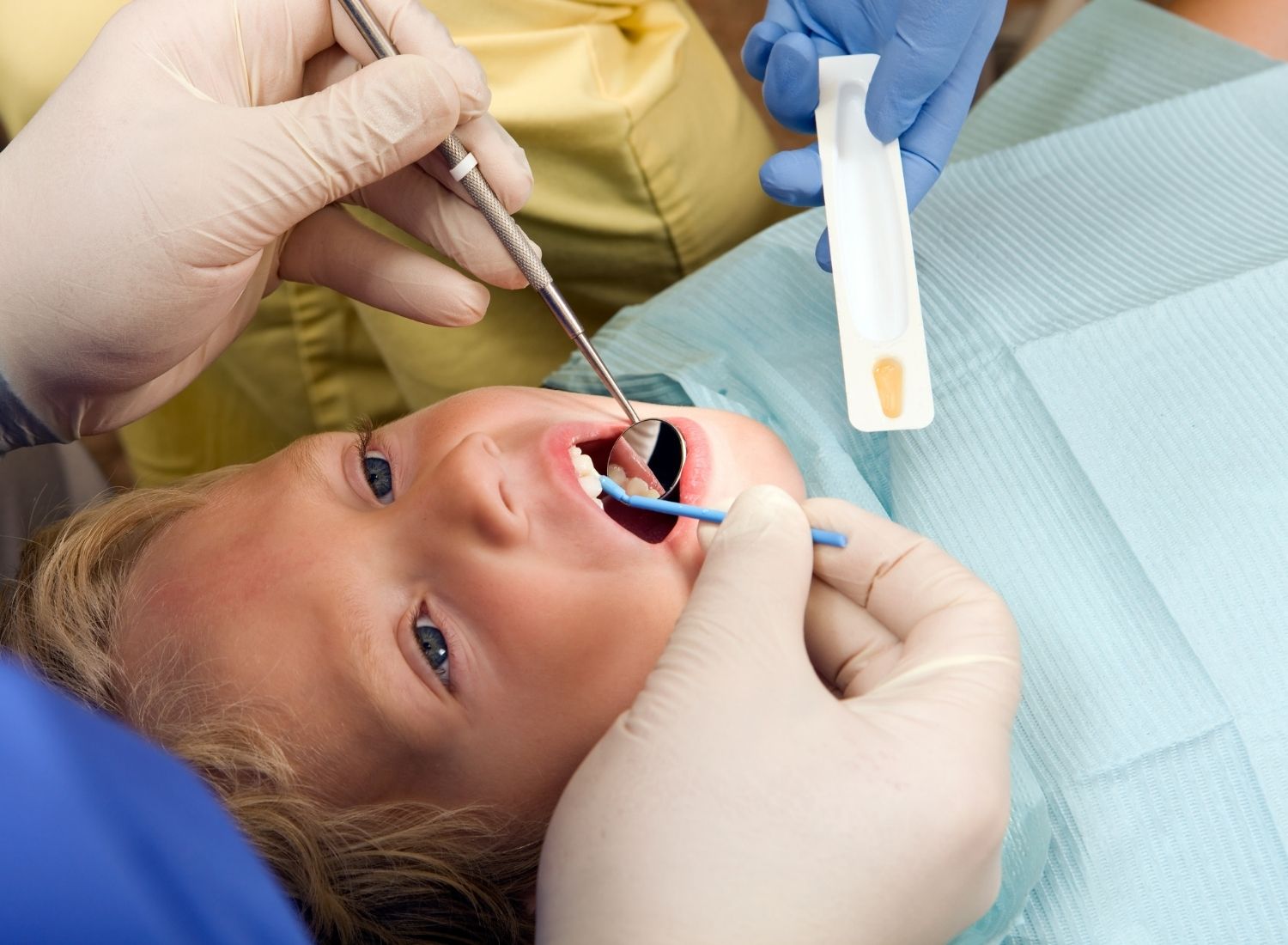 Child receiving a fluoride treatment during a dental visit.