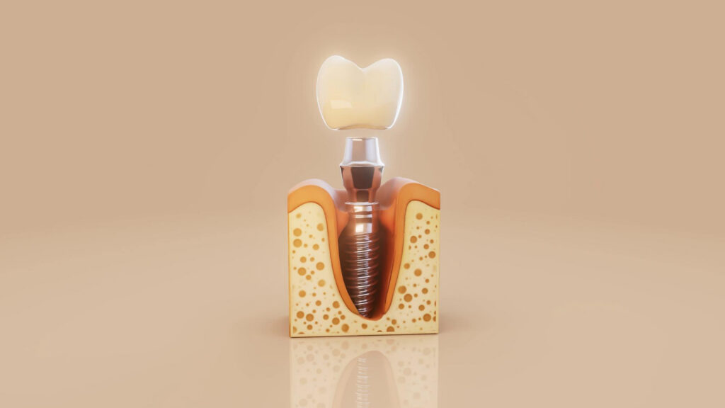implant