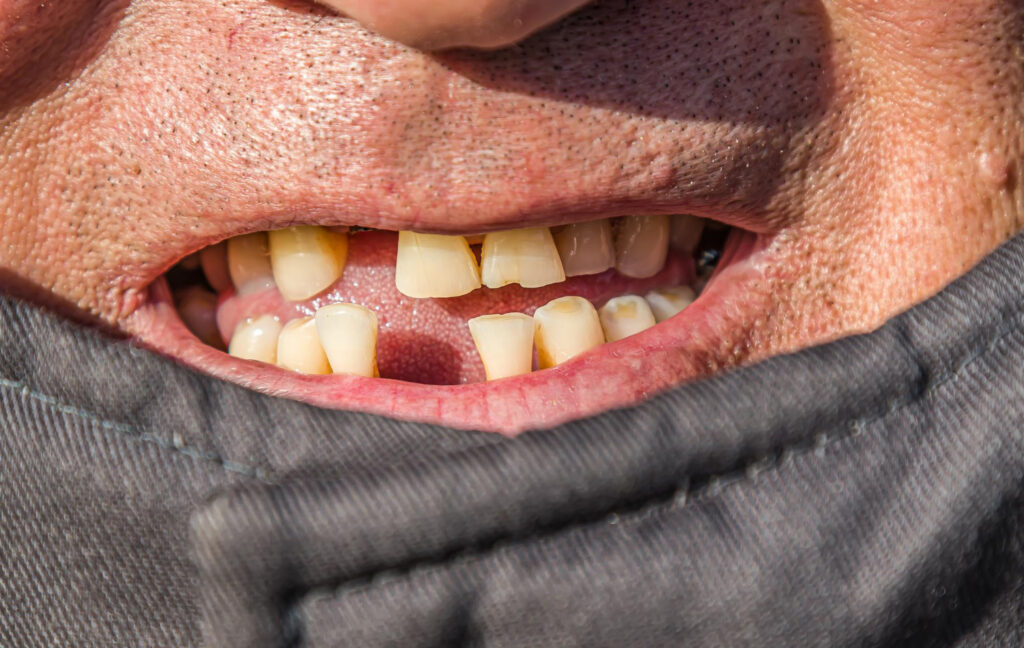 Steps to Restore Missing Teeth for Better Summer Eats