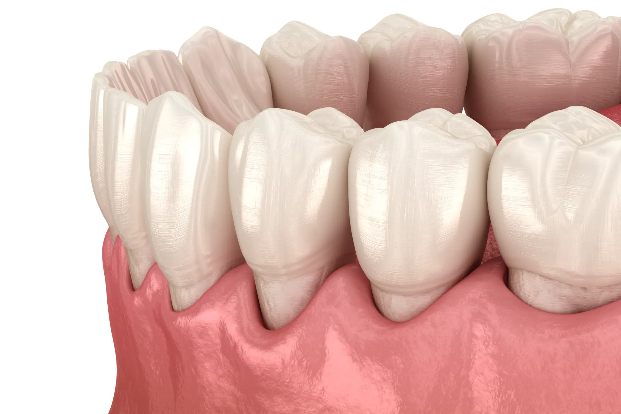 Illustration showing gum recession along the teeth and gumline.