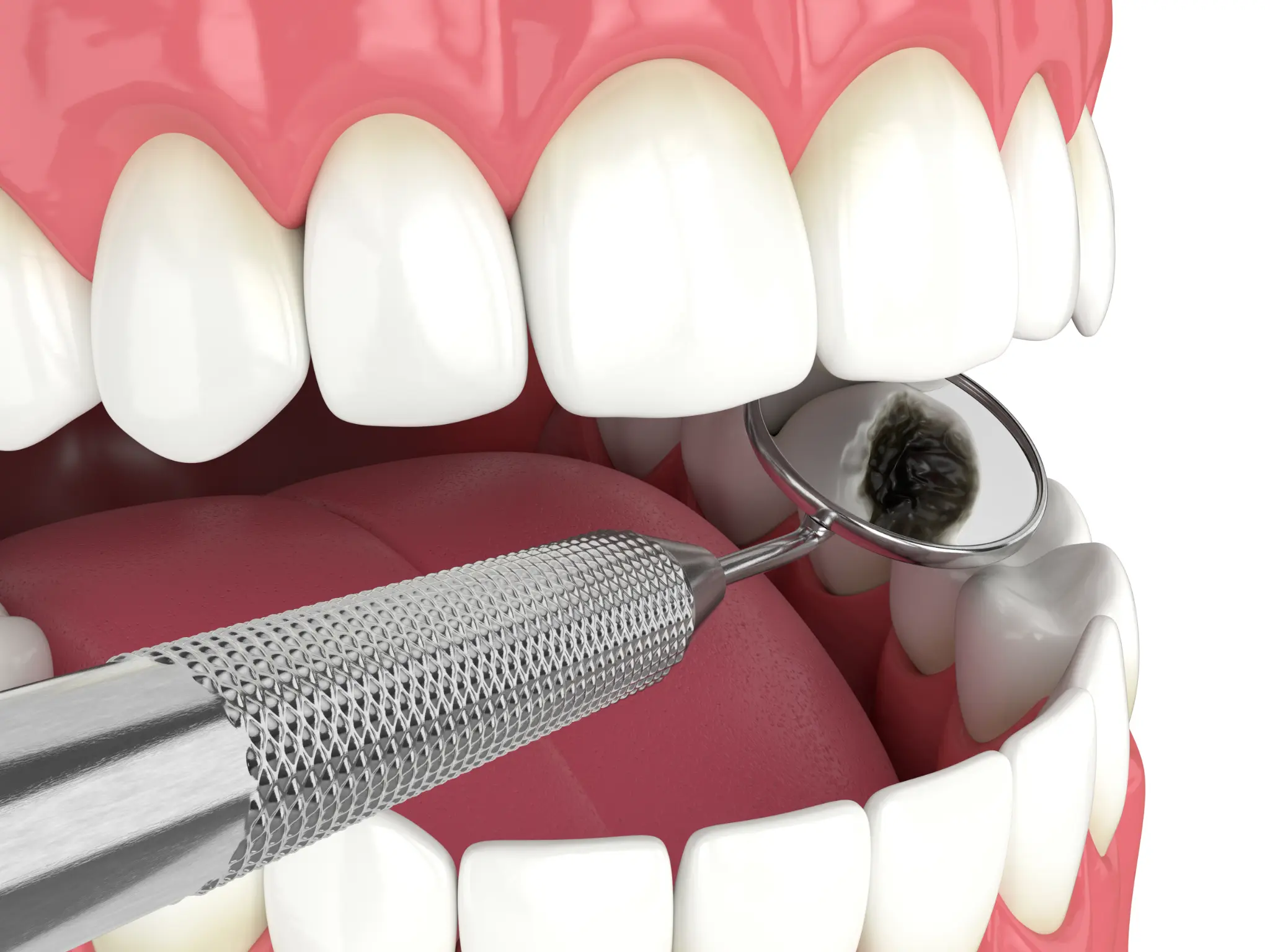Illustration of a dental mirror examining a molar.