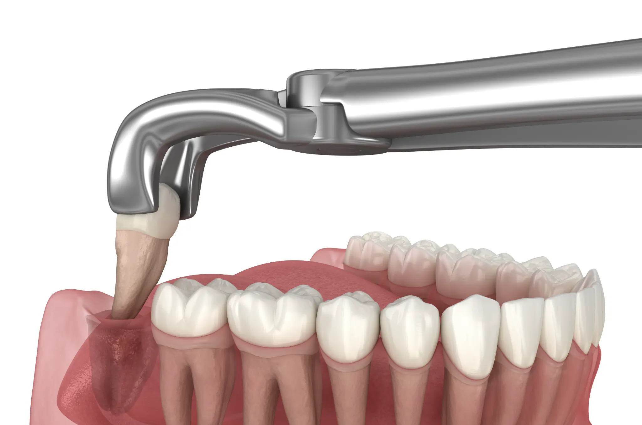 Illustration of dental forceps removing a tooth from its socket.